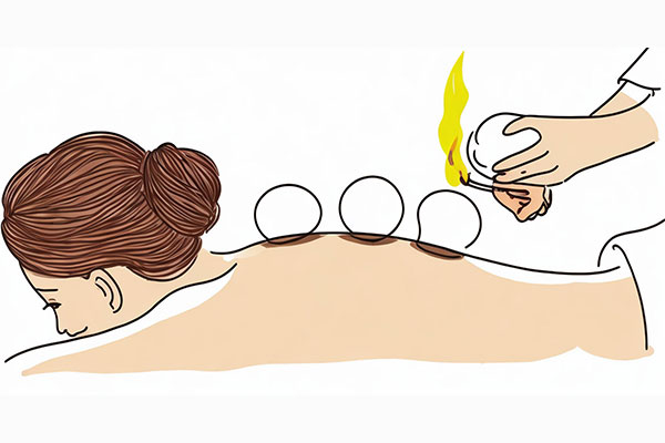 真空拔罐,拔罐,拔罐误区